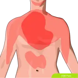 View of the chest with common areas of MI coloured