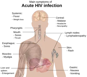 A diagram of a human torso labeled with the most common symptoms of an acute HIV infection