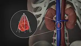 Image showing an inferior vena cava filter in its position