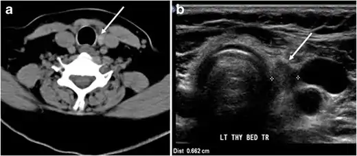 Fig. 7. A 51-year-old female patient post total thyroidectomy for PTC with elevated thyroglobulin measurement. an Axial non-enhanced CT scan of the neck at the level of the thyroid bed demonstrates a well-defined, rounded, homogenously dense soft tissue situated between the trachea and left internal jugular vein (white arrow). b Transverse ultrasound image of the neck demonstrates a well-defined, homogeneous, hypoechoic soft tissue nodule measuring 6&nbsp;mm (white arrow) with no detected micro-calcifications. Biopsy showed a predominantly residual normal thyroid tissue with micro-foci of PTC.