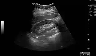 Normal adult right kidney as seen on abdominal ultrasound with a pole to pole measurement of 9.34&nbsp;cm.