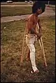Young man in full leg plaster cast in 1974